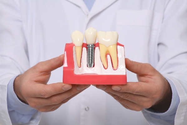 How Long Do Dental Implants Last?