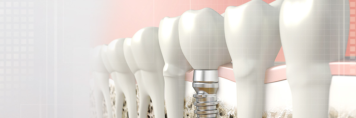 Los Angeles Implant Dentist