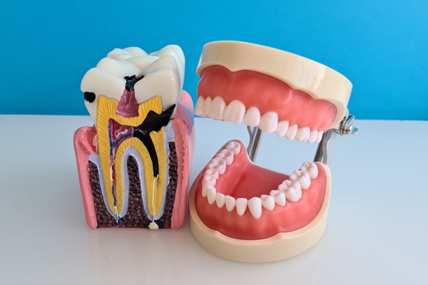 The Root Canal Procedure Explained: Step By Step